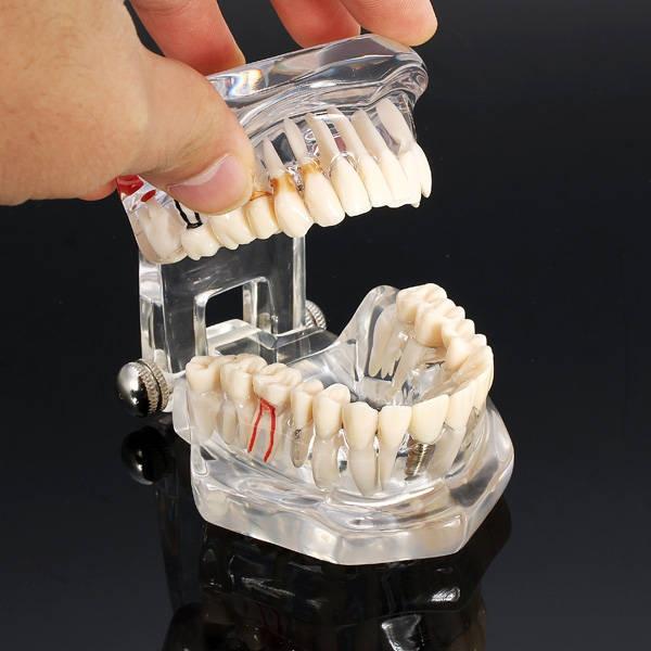 Detachable Teaching Dental Disease Teeth Implantation Model