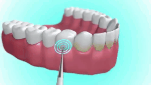 Electric Ultrasonic Tooth Stain Eraser